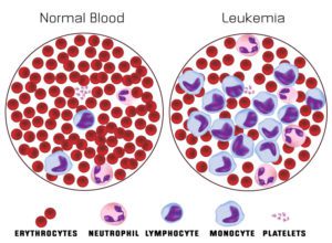 Normal Blood Smear vs Acute Myeloid Leukemia Blood Smear
